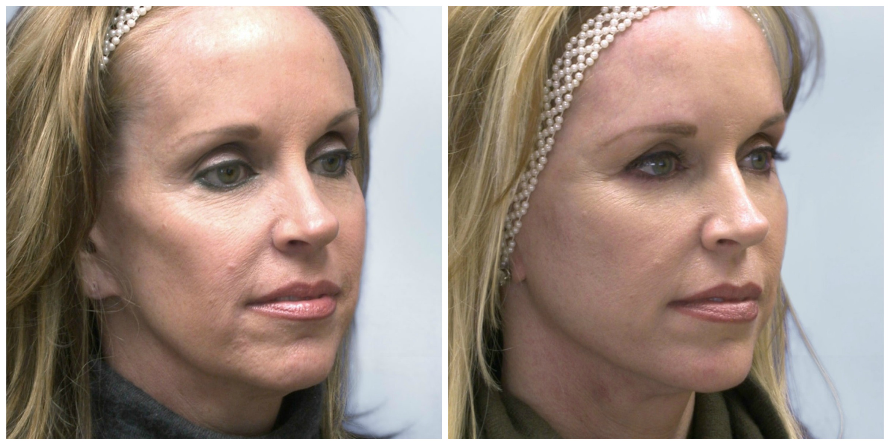 Spectacular Sculptra ReGrow Your Own Collagen with This Amazing Facial Volumizer Body Tonic