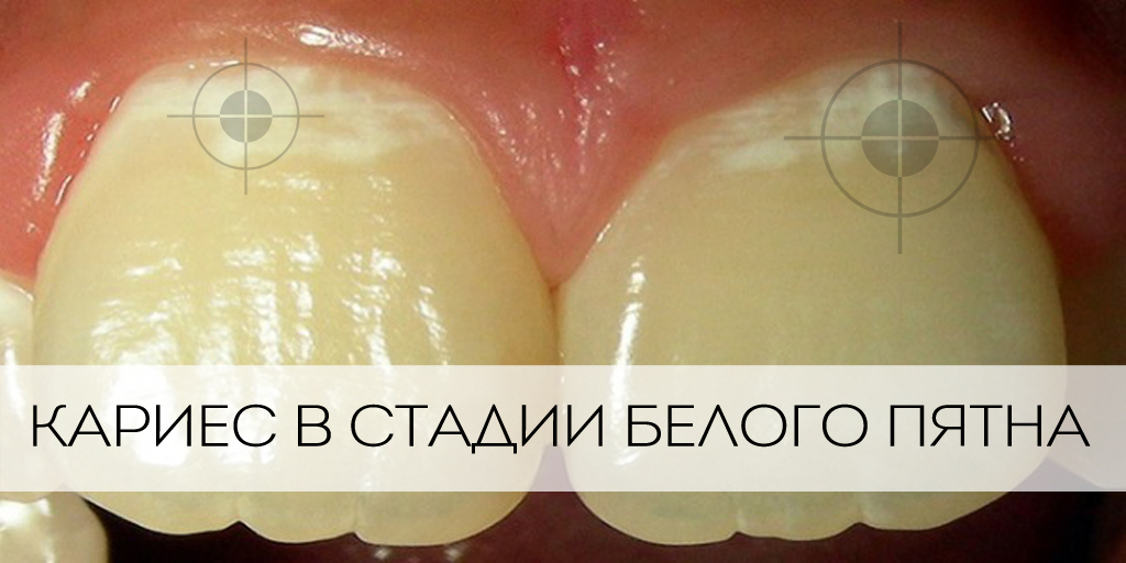 Желтые пигментные пятна на зубах
