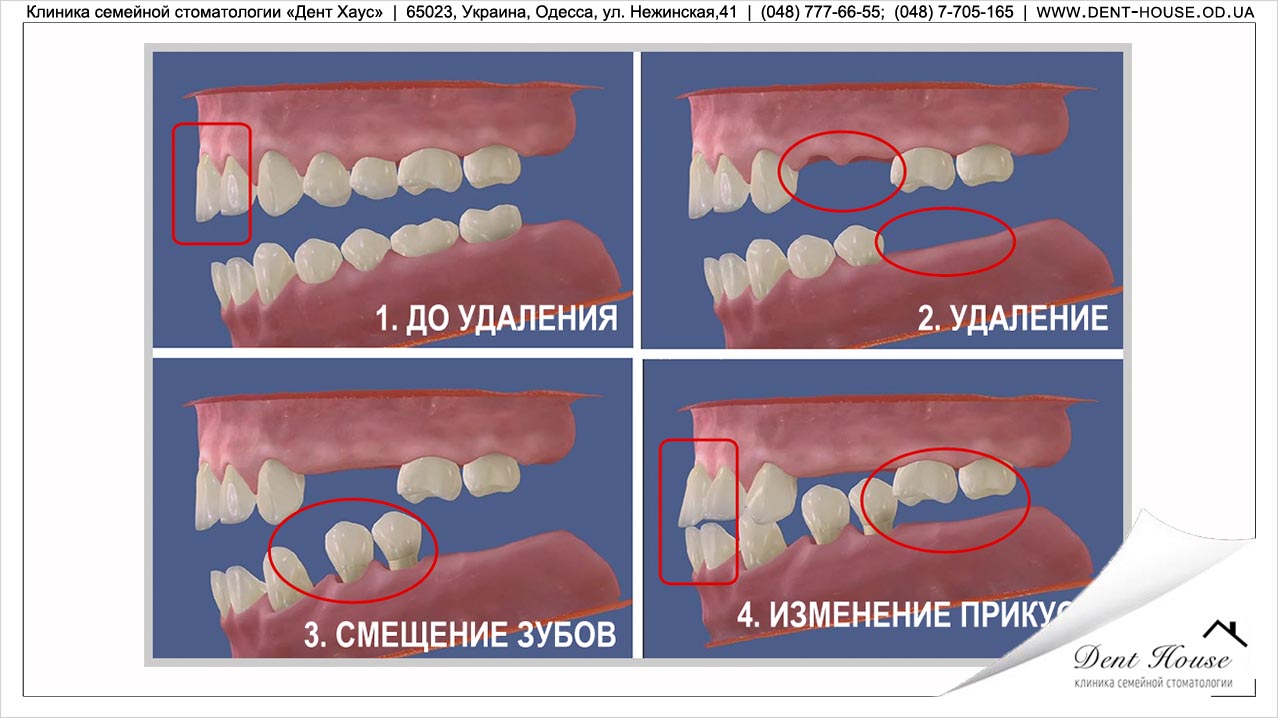 Сместились зубы после удаления зуба мудрости Сместились зубы после удаления зуба мудрости