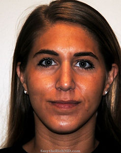 cart-ap-nose-after.jpg