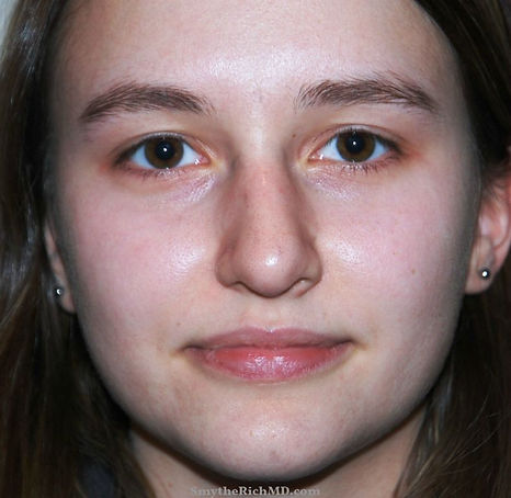 Rhinoplasty1-frontview-before.jpg