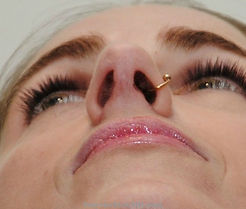 Nasal-obstruction-after.jpg
