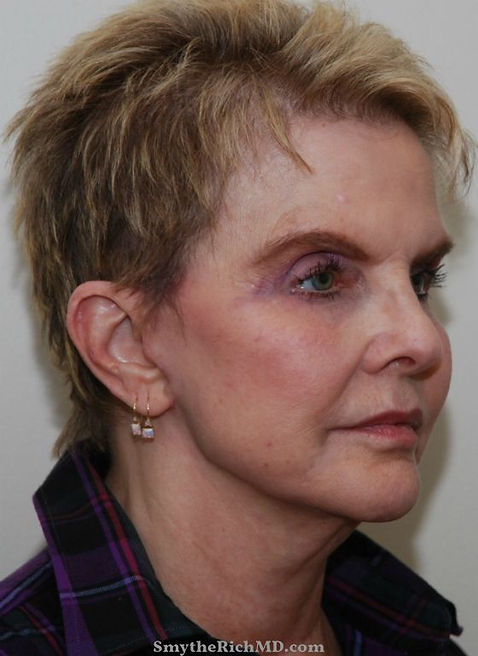 facelift-after.jpg