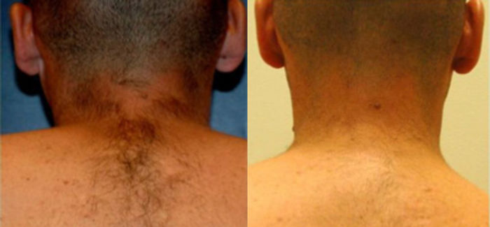 laser-hair-removal-before-after-side-by-