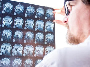 Can CBD Help Prevent Seizures?