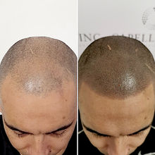 Professional SMP treatment improving hairline and self-confidence