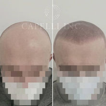 Professional SMP treatment improving hairline and self-confidence