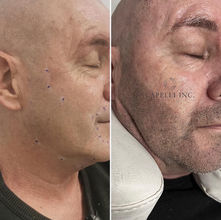 Professional SMP treatment improving hairline and self-confidence