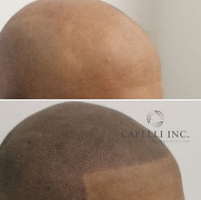 Professional SMP treatment improving hairline and self-confidence