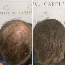 Professional SMP treatment improving hairline and self-confidence