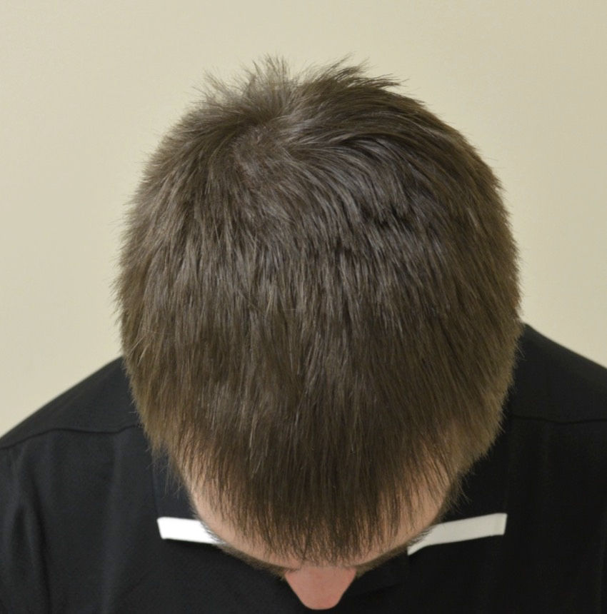 After frontal hairline restoration