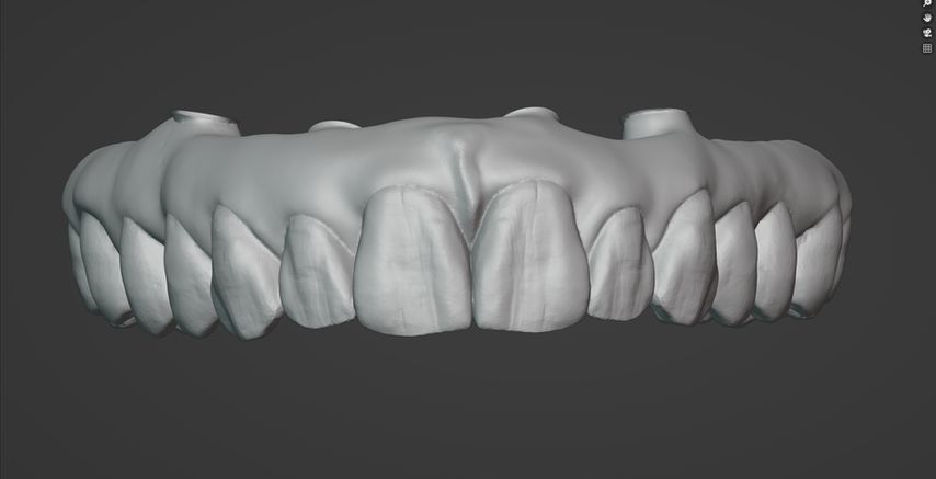 Aesthetic Final Restorations