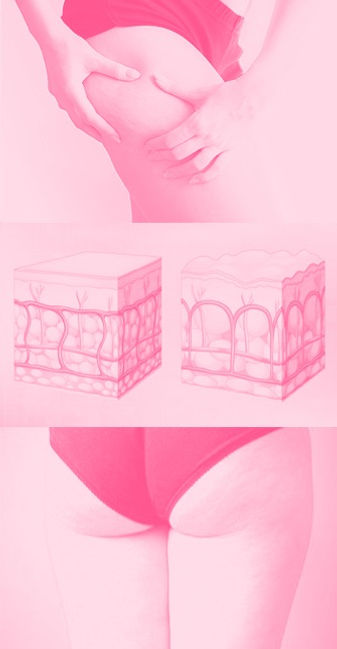 celulite_lateral_edited.jpg