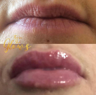 lip injection.jpg