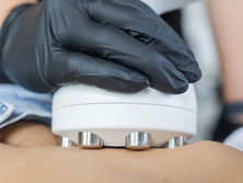 Smooth Away Cellulite with RF Cellulite Reduction at Triangle Laser & Aesthetic Center