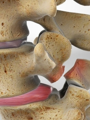 Espondilolistese – Causas e Tratamentos Cirúrgicos