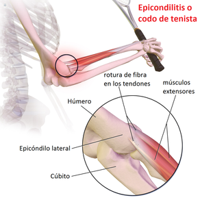 EPICONDILITIS o "Codo del tenista"