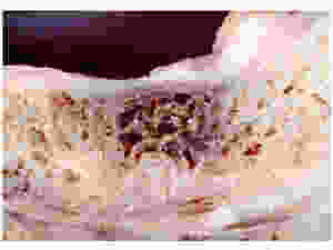 Cross section of the jawbone showing a hollow area with necrotic (dead) tissue