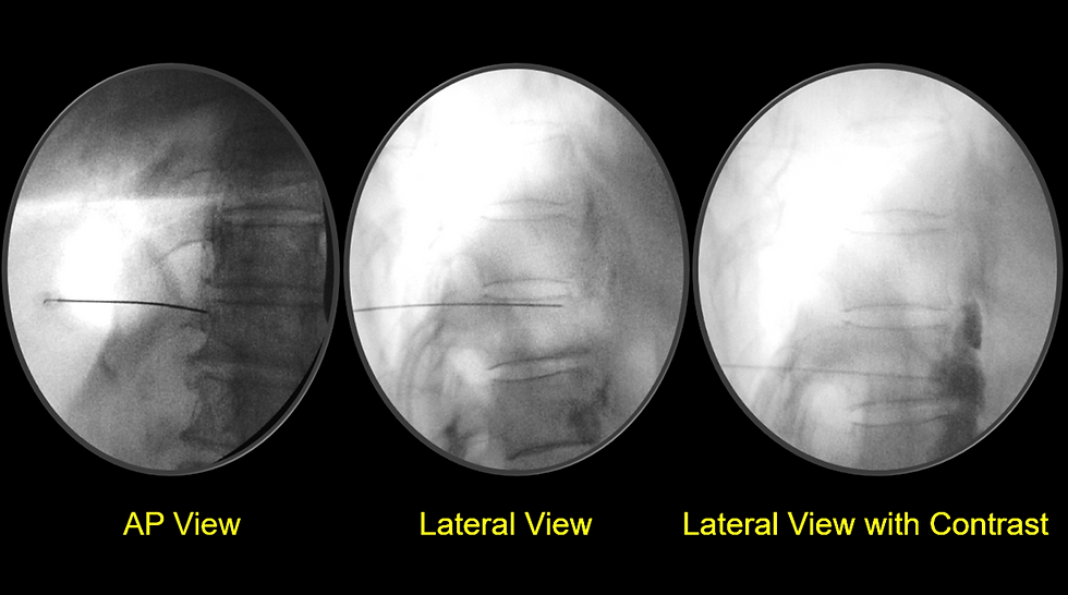 Needle Positioning For Splanchnic Nerve Block,Three circular X-ray views of a spine show AP, Lateral, and Lateral with contrast. Each view labeled in yellow text on a black background.
