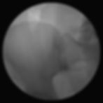 Grayscale X-ray close-up of a hip joint and pelvis, with bones filling a circular scan area on a black background.