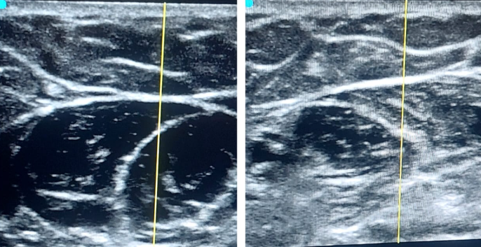 Ultrasound Guided Stellate Ganglion Block for CRPS