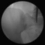 Grayscale X-ray view of a hip/pelvis with a medical probe or instrument near the joint in a clinical setting, needle entry For Sacroiliac joint injection under the C-arm