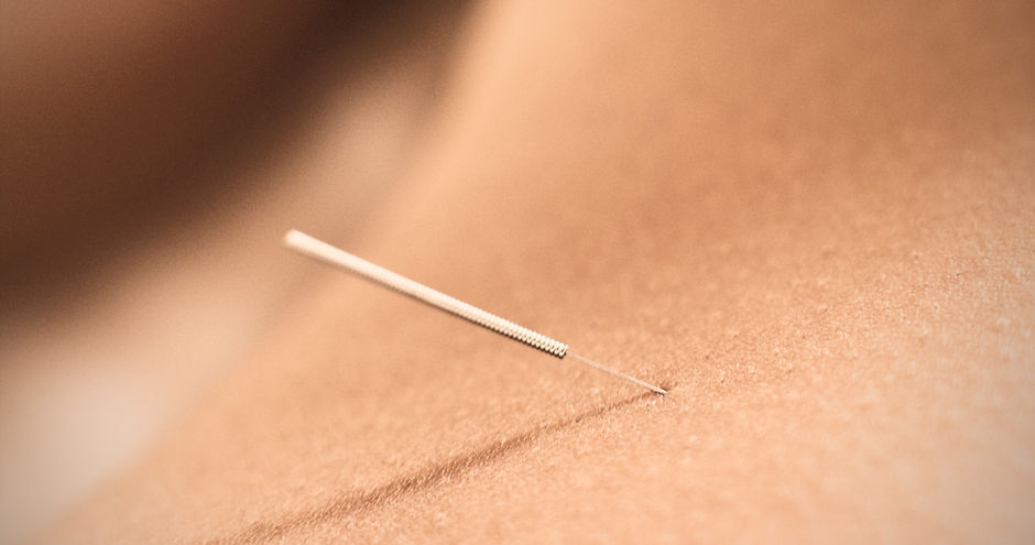 Woman%20Receiving%20Acupuncture_edited.jpg