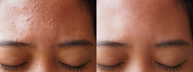 befor and after acne treatment