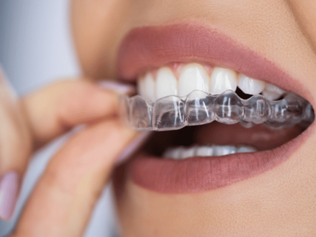 Why More People Are Turning to This Dental Night Guard for Better Sleep