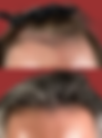 Hair Transplant Specialists vs. General Surgeons: Why Expertise Matters