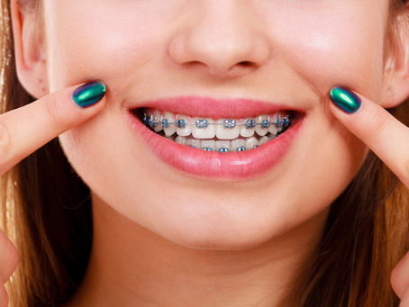 5 Tips to Properly Care for Your Braces