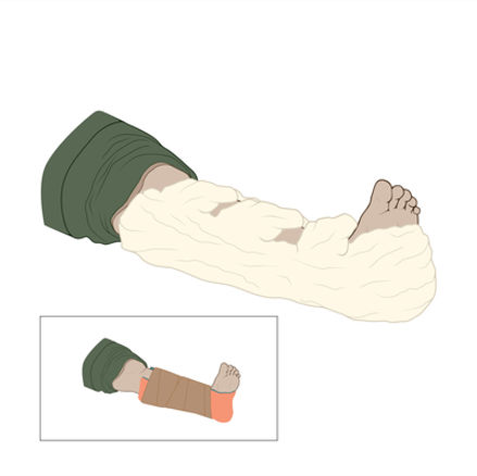 A step-by-step guide showing the use of a spray foam splint.