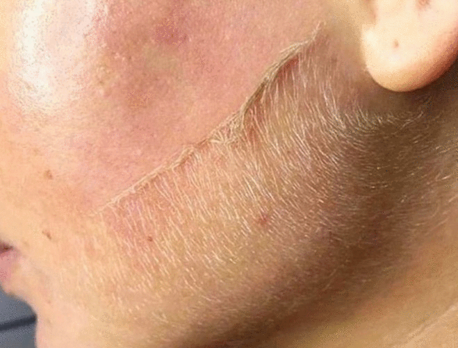 dermaplane, dermaplaning, close up, face hair, smooth skin,