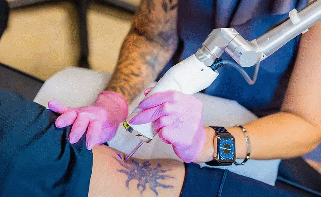 cutera enlighten 3, enlighten, cutera, tattoo laser,