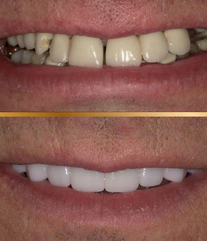 Before and after of an all-on-4 maxillary denture.