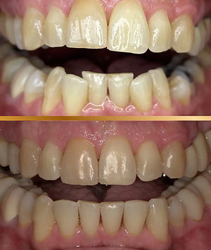Before and after of Invsialign clear aligners.