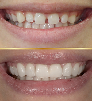 Before_after - 1.png