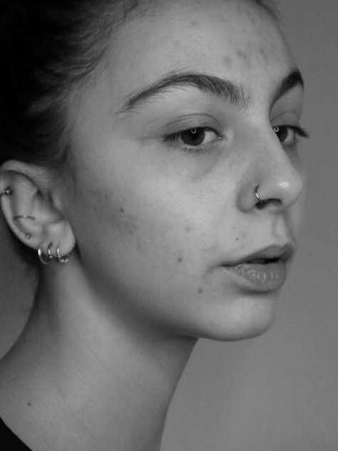 Tips To Conceal Acne