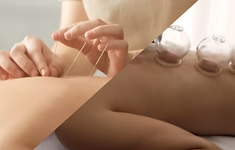 acupuncture and cupping in las olas, acupuncture in fort lauderdale, cupping in fort laude