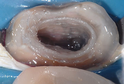 Dr. Andras Forster demonstrating cavity preparation for a biomimetic restoration.