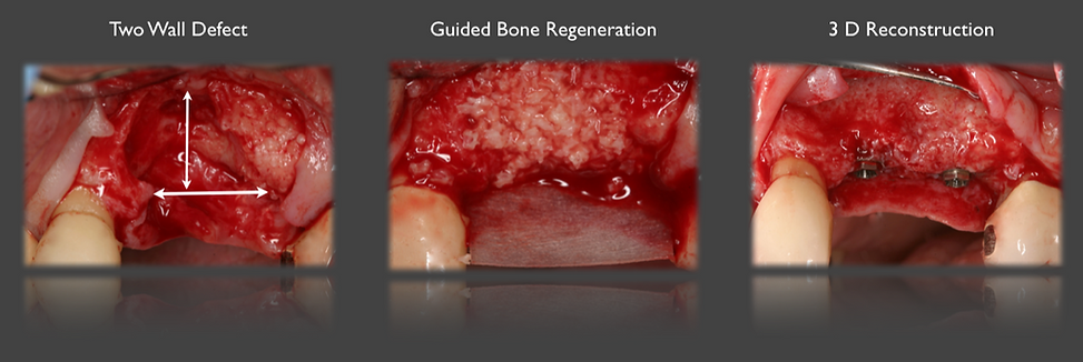 Guided bone regeneration with a two-wall defect and 3D reconstruction by Dr. Alina Krivitsky.
