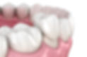 3D-dental-crown-placement.jpg