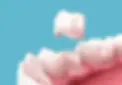 dental-crown-placement-over-tooth-600nw-2473541351 (1).webp