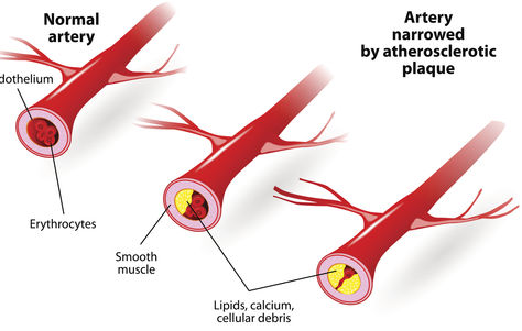 Could This Scan Predict Your Risk of a Heart Attack?
