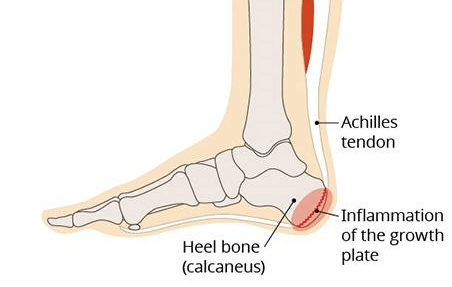 growth plate heel