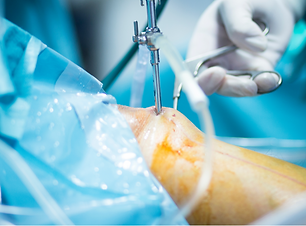 Revision ACL Reconstruction | The orthopaedic Clinic | Bangalore