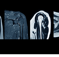 Roator Cuff Tear Cause | The Orthopaedic Clinic | Bangalore