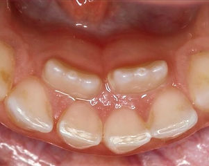 dientes-tiburon-ninos_edited_edited.jpg