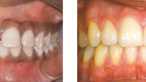 Pigmented gingiva – How oral ailments may present differently based on the color of gingiva