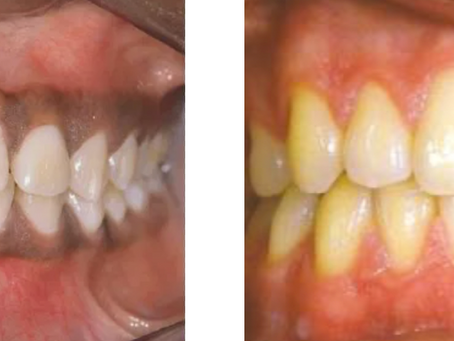 Pigmented gingiva – How oral ailments may present differently based on the color of gingiva